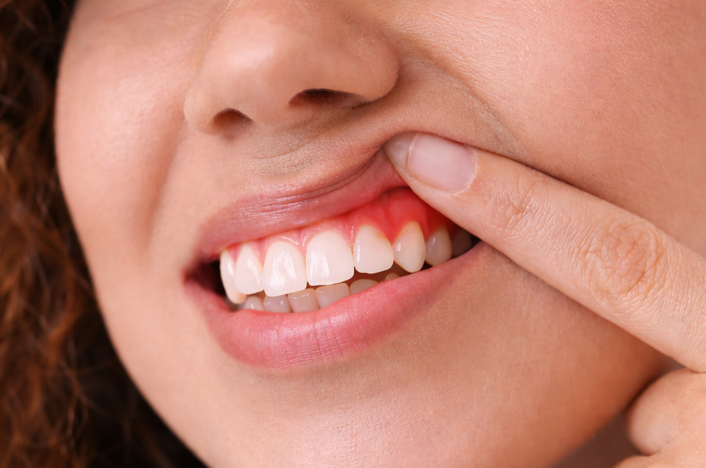 Флюс на десне: симптомы, лечение и что будет, если не лечить