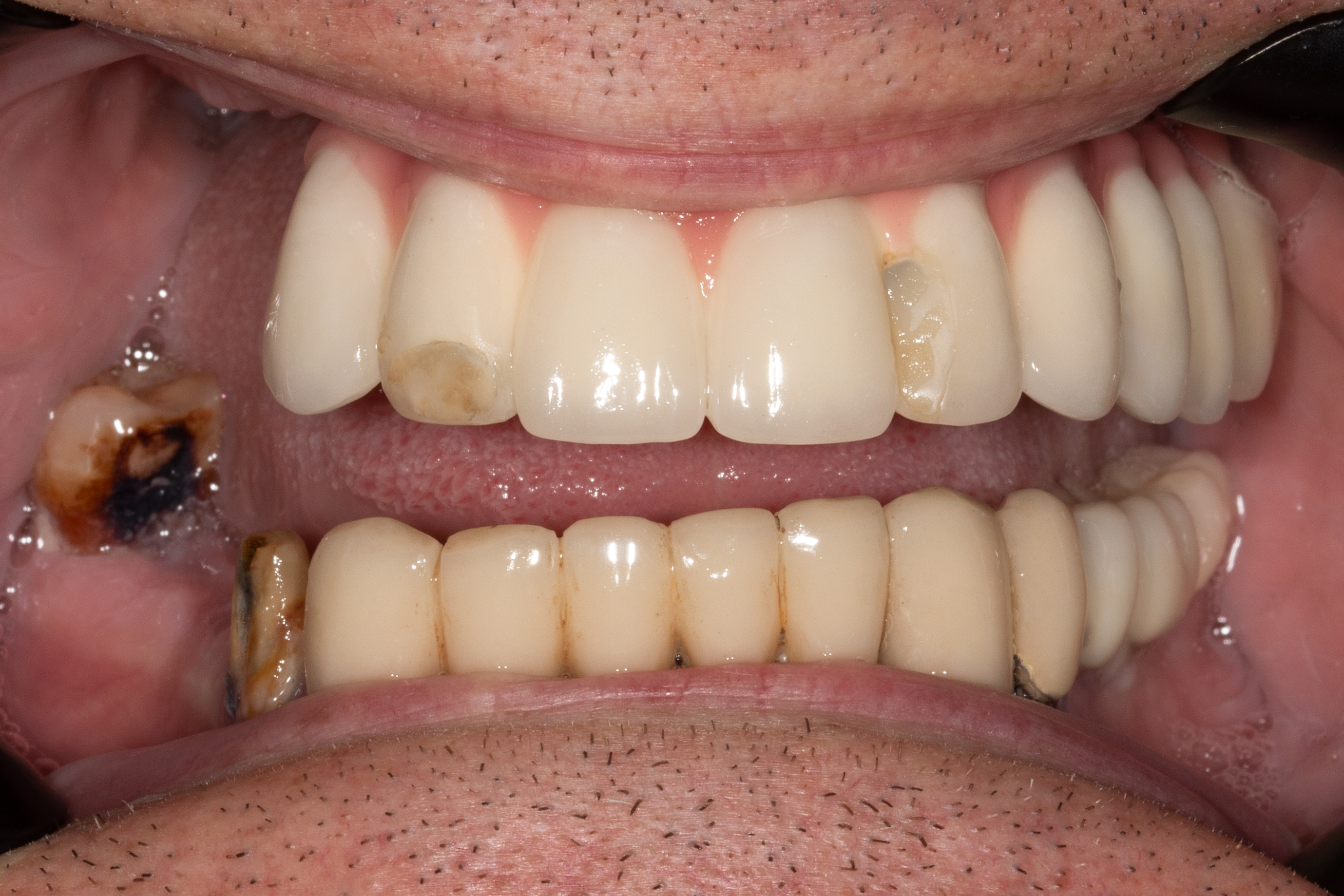 Имплантация верхней и нижней челюсти швейцарскими имплантами ROOTT - до