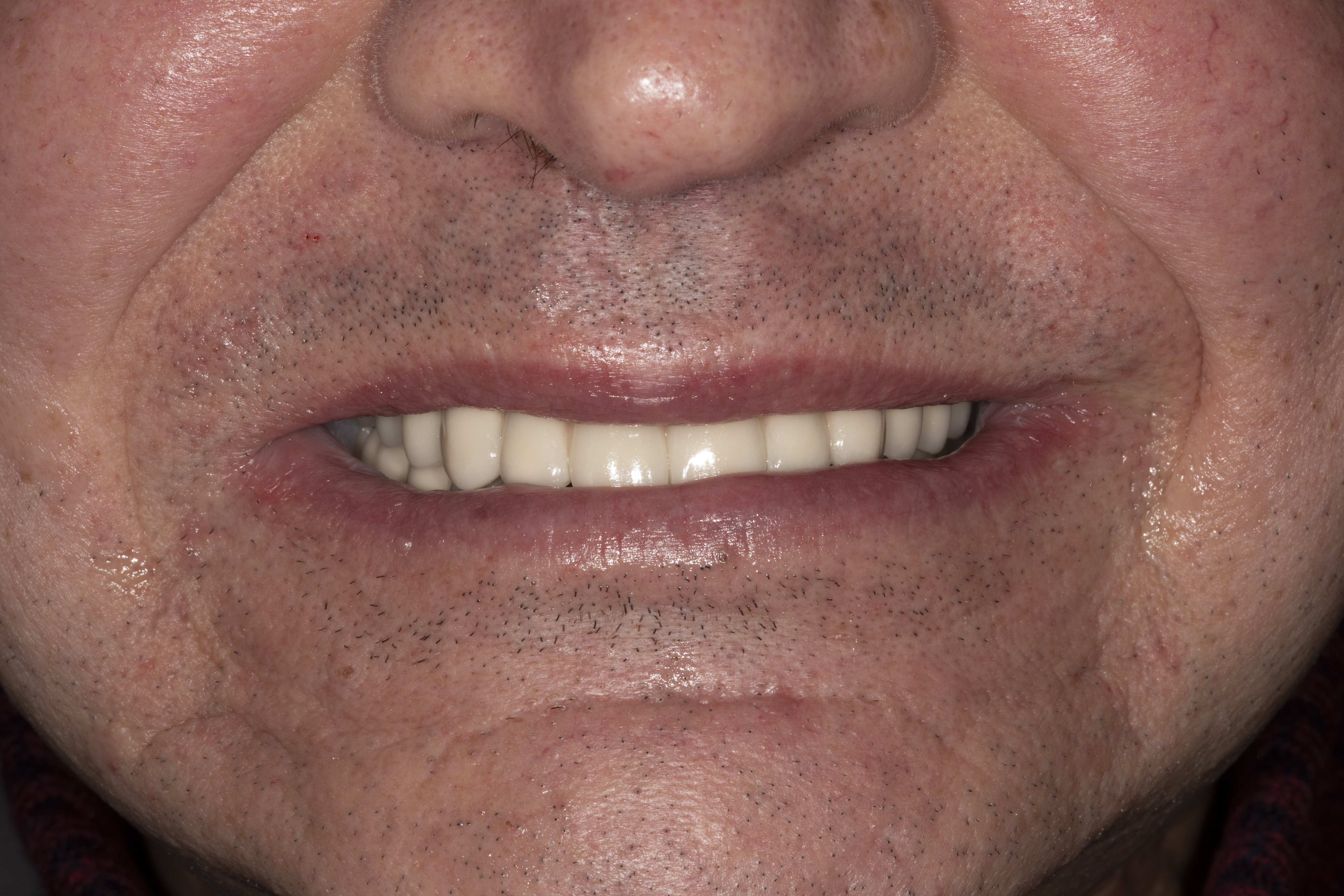 Имплантация верхней и нижней челюсти швейцарскими имплантами ROOTT - после