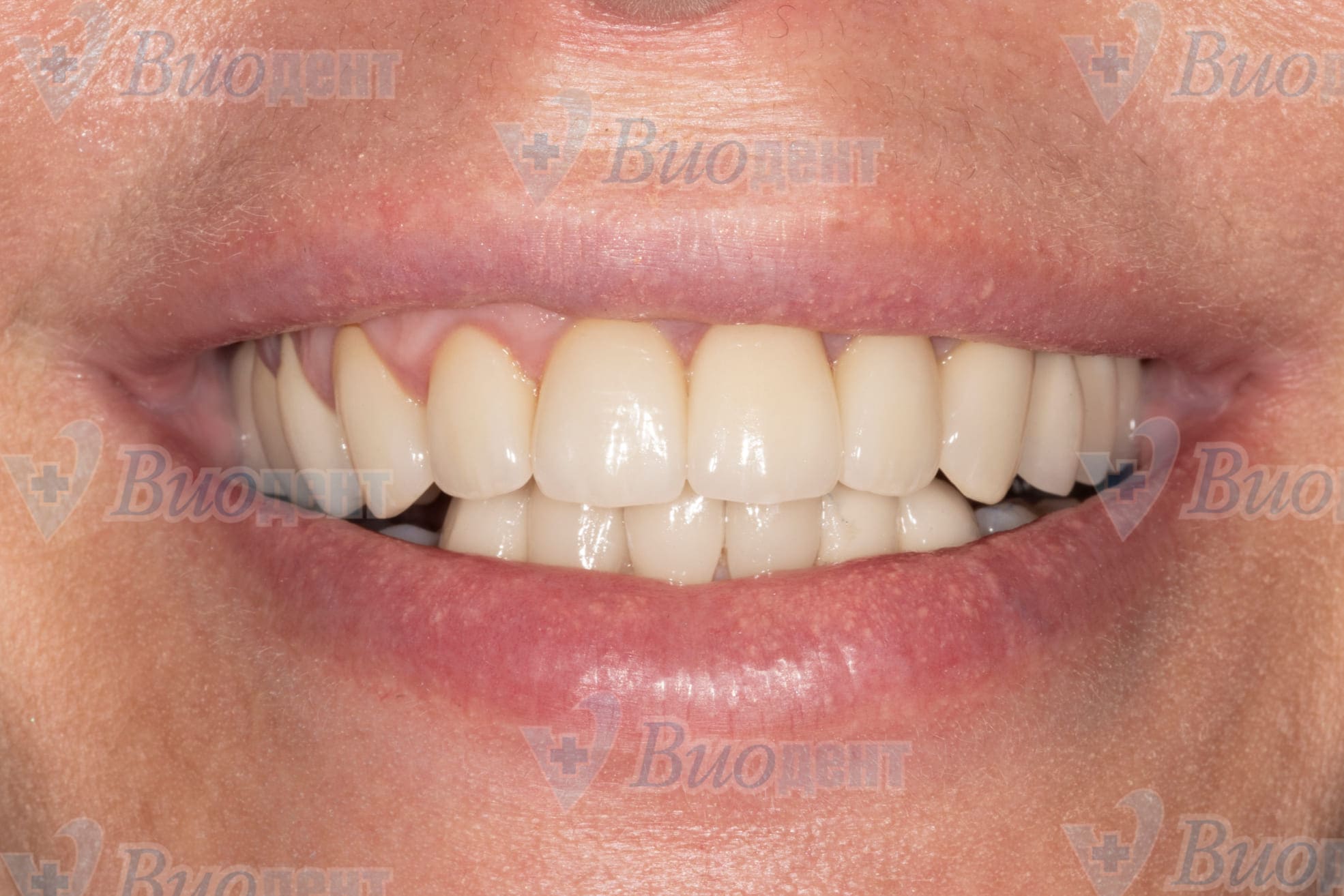 Имплантация жевательных зубов - после