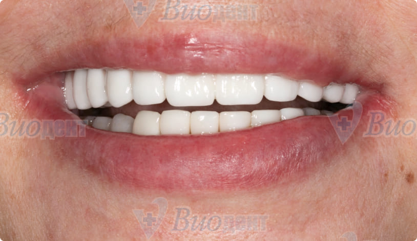 Восстановление зубов на обеих челюстях с помощью имплантации ROOTT - после