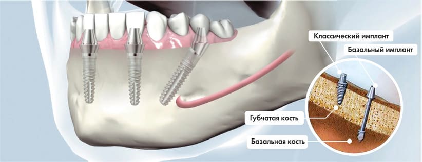 Базальная имплантация. Базальная имплантация зубов. Базальная имплантация зубов цена. Базальный слой при имплантации зубов.