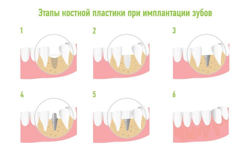 Как и для чего делают наращивание костной ткани при имплантации зубов?