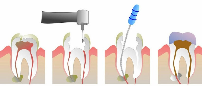 Каналы корней зуба