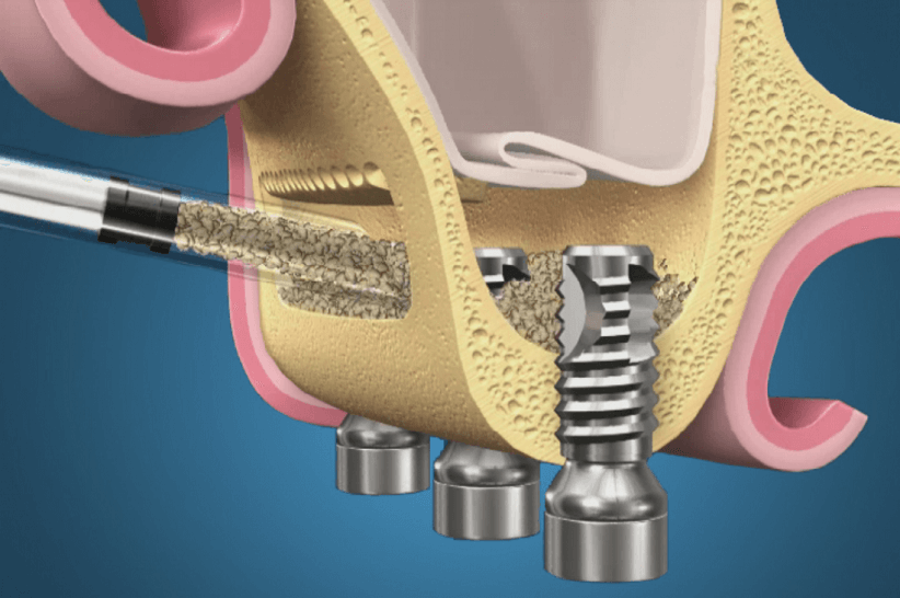 Синус лифтинг в стоматологии
